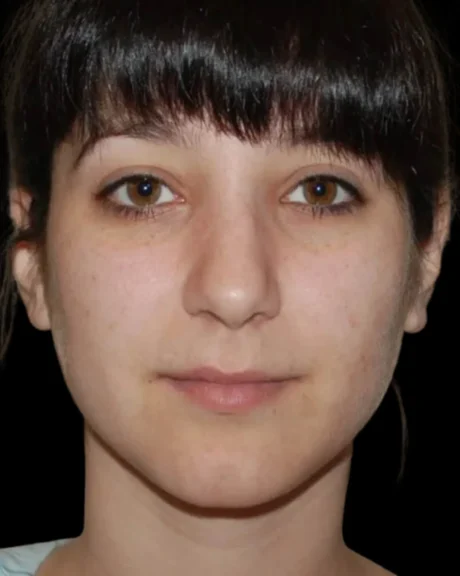 Rhinoplasty case #13272