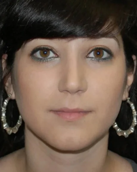 Rhinoplasty case #13272