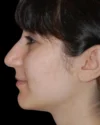 Rhinoplasty case #13272