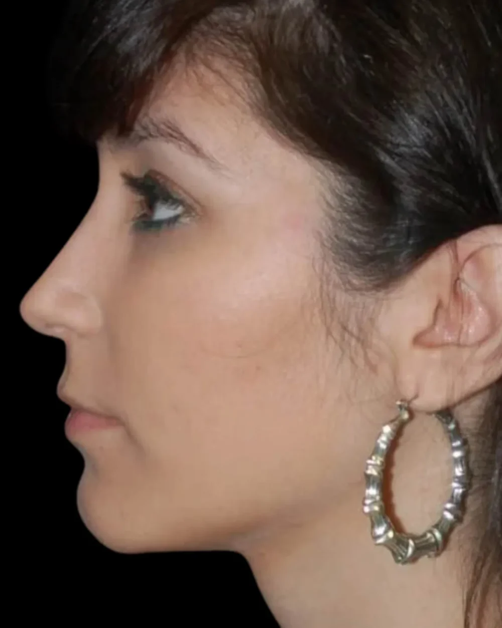 Rhinoplasty case #13272