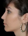 Rhinoplasty case #13272