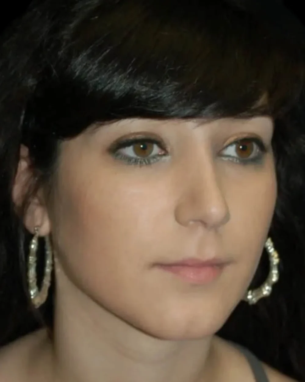 Rhinoplasty case #13272