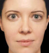 Rhinoplasty case #12856