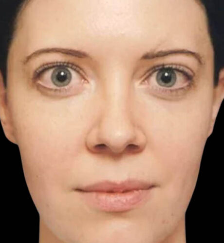 Rhinoplasty case #12856
