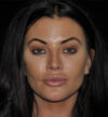 Rhinoplasty case #13086