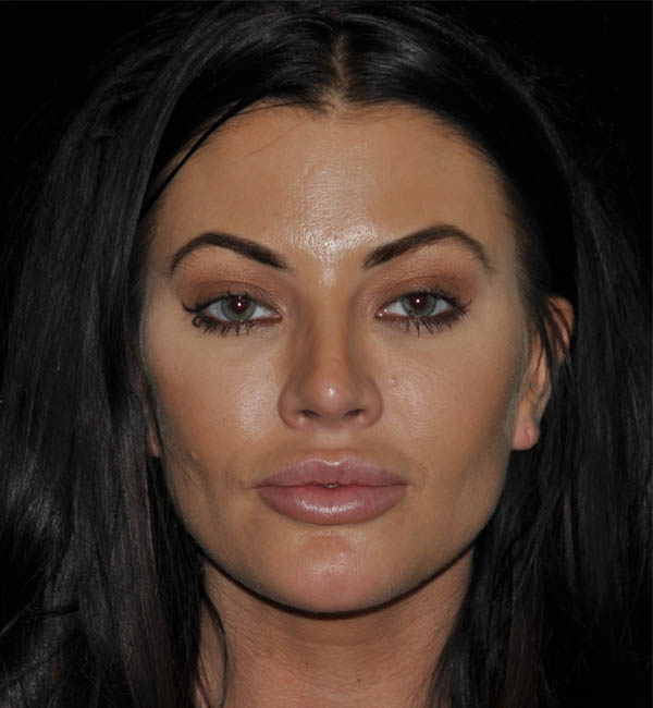 Rhinoplasty case #13086
