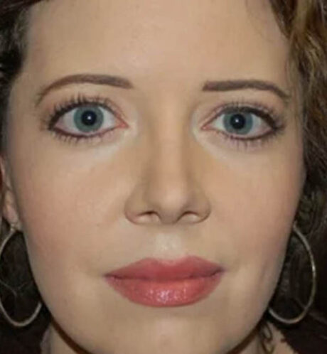 Rhinoplasty case #12856