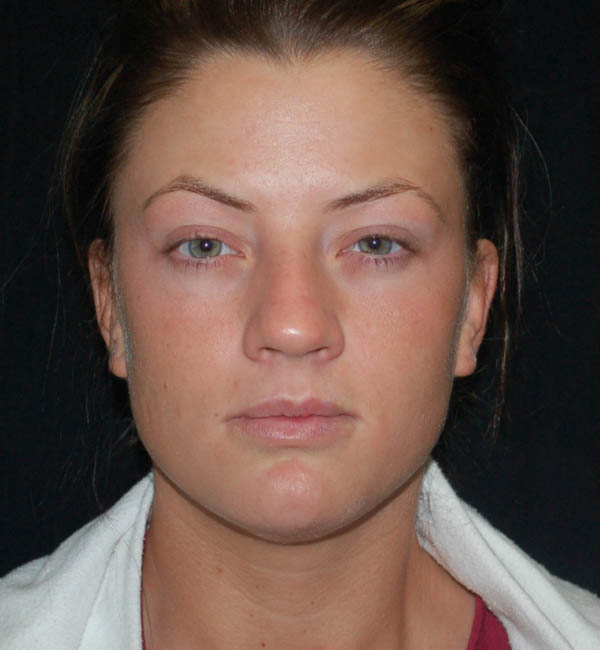 Rhinoplasty case #13086