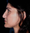 Revision Rhinoplasty case #13485