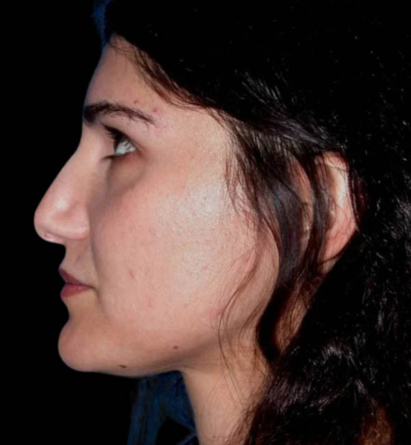 Revision Rhinoplasty case #13485