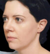 Rhinoplasty case #12856