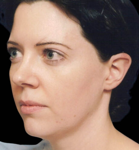 Rhinoplasty case #12856