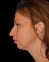 Profile Balancing case #12698