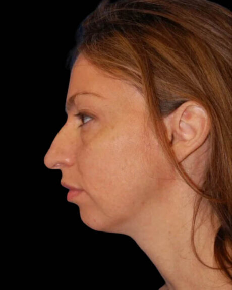Profile Balancing case #12698