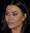Rhinoplasty case #13086