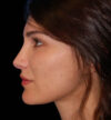 Revision Rhinoplasty case #13485