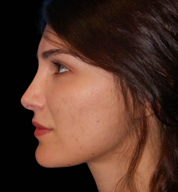 Revision Rhinoplasty case #13485