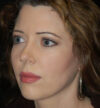 Rhinoplasty case #12856
