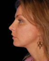 Profile Balancing case #12698