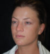 Rhinoplasty case #13086