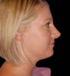 Revision Rhinoplasty case #13397