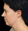 Rhinoplasty case #12856