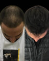 FUE Hair and Eyebrow Transplant case #12739