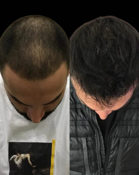 FUE Hair and Eyebrow Transplant case #12739