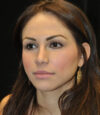 Revision Rhinoplasty case #13493