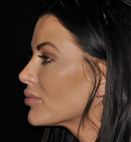 Rhinoplasty case #13086