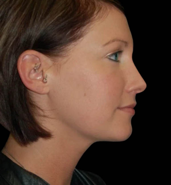 Revision Rhinoplasty case #13397