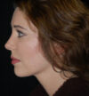 Rhinoplasty case #12856