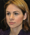 Revision Rhinoplasty case #13493