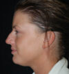 Rhinoplasty case #13086