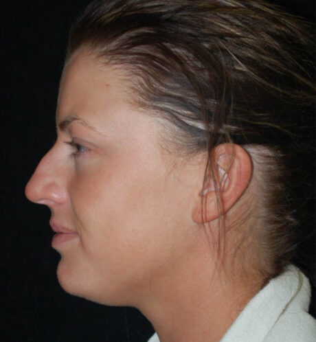 Rhinoplasty case #13086