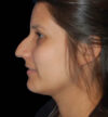 Rhinoplasty case #13243