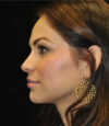 Revision Rhinoplasty case #13493