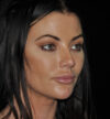 Rhinoplasty case #13086