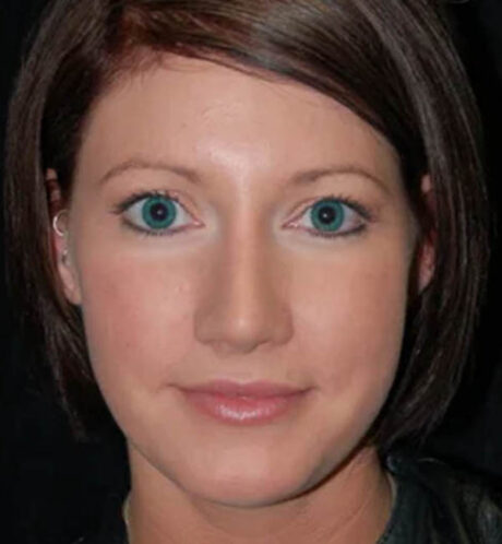 Revision Rhinoplasty case #13397