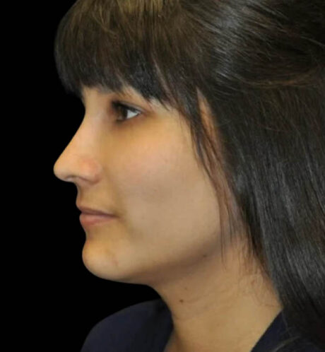 Rhinoplasty case #13243