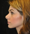Revision Rhinoplasty case #13493