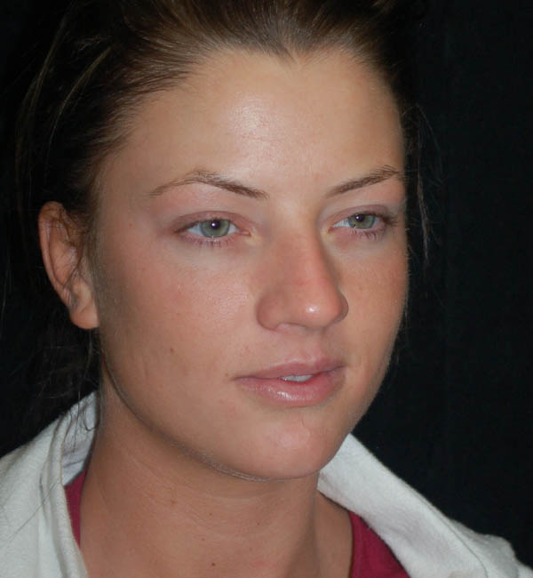 Rhinoplasty case #13086