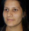 Rhinoplasty case #13243