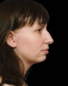 Profile Balancing case #12730