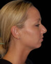 Profile Balancing case #12727