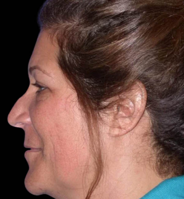 Revision Rhinoplasty case #13423