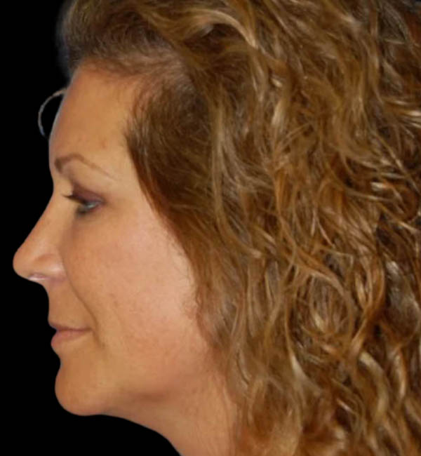 Revision Rhinoplasty case #13423