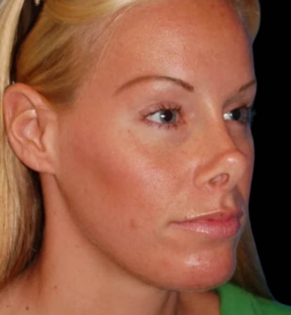 Revision Rhinoplasty case #13387