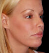 Revision Rhinoplasty case #13387