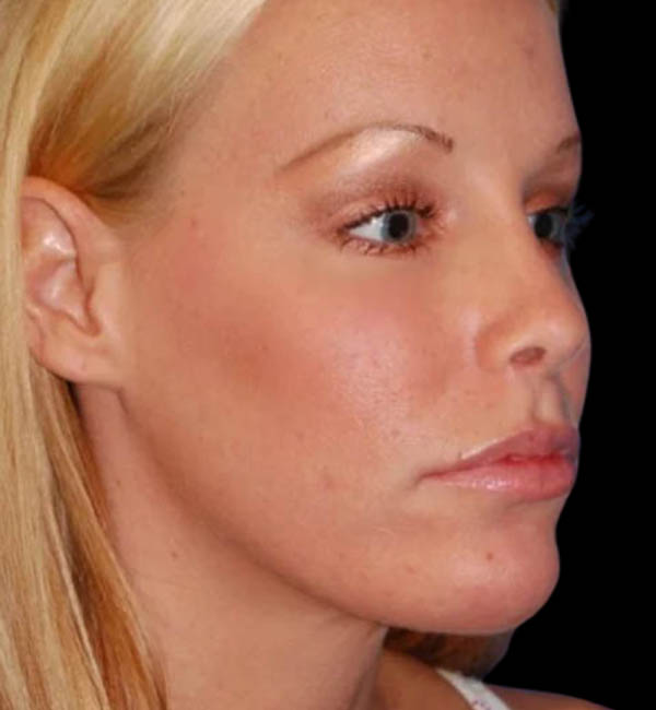 Revision Rhinoplasty case #13387